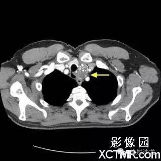 【双语病例】原发性气管软管肉瘤1例 【双语病例】原发性气管软管肉瘤1例