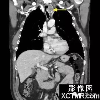 【双语病例】原发性气管软管肉瘤1例 【双语病例】原发性气管软管肉瘤1例
