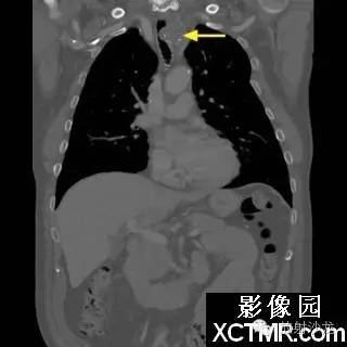 【双语病例】原发性气管软管肉瘤1例 【双语病例】原发性气管软管肉瘤1例