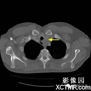 【双语病例】原发性气管软管肉瘤1例 【双语病例】原发性气管软管肉瘤1例