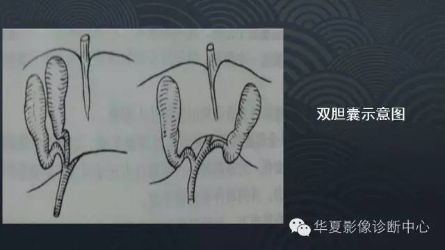 【PPT】胆囊先天性变异