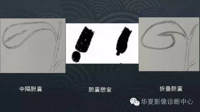 【PPT】胆囊先天性变异