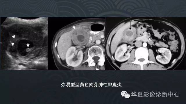 【PPT】黄色肉芽肿性胆囊炎