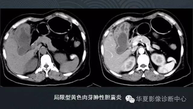 【PPT】黄色肉芽肿性胆囊炎