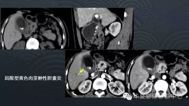 【PPT】黄色肉芽肿性胆囊炎