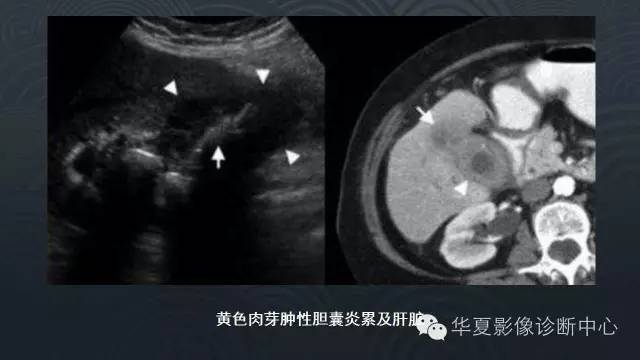【PPT】黄色肉芽肿性胆囊炎