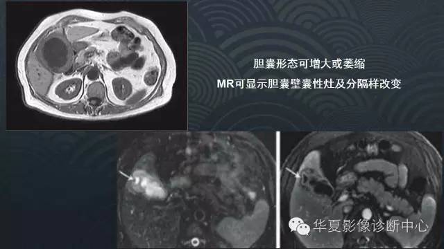 【PPT】黄色肉芽肿性胆囊炎