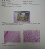【病例】左侧臀部促结缔组织增生性纤维母细胞瘤1例 【病例】左侧臀部促结缔组织增生性纤维母细胞瘤1例