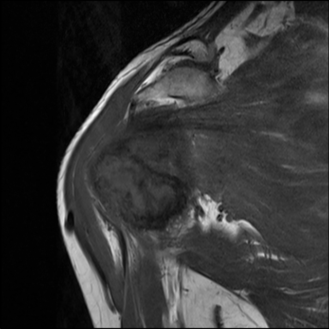 【病例】肱骨上段骨巨细胞瘤1例MR影像表现 【病例】肱骨上段骨巨细胞瘤1例MR影像表现