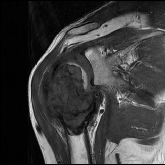 【病例】肱骨上段骨巨细胞瘤1例MR影像表现 【病例】肱骨上段骨巨细胞瘤1例MR影像表现