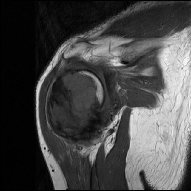 【病例】肱骨上段骨巨细胞瘤1例MR影像表现 【病例】肱骨上段骨巨细胞瘤1例MR影像表现