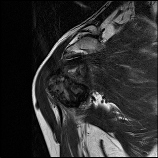 【病例】肱骨上段骨巨细胞瘤1例MR影像表现 【病例】肱骨上段骨巨细胞瘤1例MR影像表现