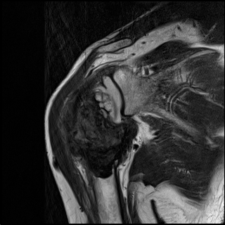 【病例】肱骨上段骨巨细胞瘤1例MR影像表现 【病例】肱骨上段骨巨细胞瘤1例MR影像表现