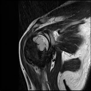 【病例】肱骨上段骨巨细胞瘤1例MR影像表现 【病例】肱骨上段骨巨细胞瘤1例MR影像表现