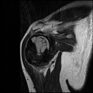 【病例】肱骨上段骨巨细胞瘤1例MR影像表现 【病例】肱骨上段骨巨细胞瘤1例MR影像表现