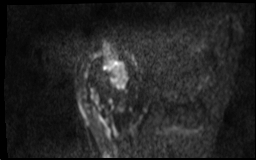 【病例】肱骨上段骨巨细胞瘤1例MR影像表现 【病例】肱骨上段骨巨细胞瘤1例MR影像表现