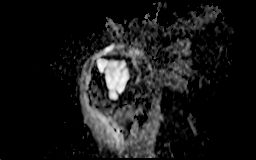 【病例】肱骨上段骨巨细胞瘤1例MR影像表现 【病例】肱骨上段骨巨细胞瘤1例MR影像表现