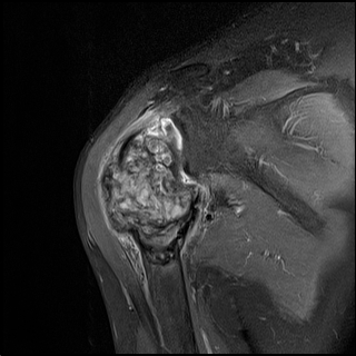 【病例】肱骨上段骨巨细胞瘤1例MR影像表现 【病例】肱骨上段骨巨细胞瘤1例MR影像表现
