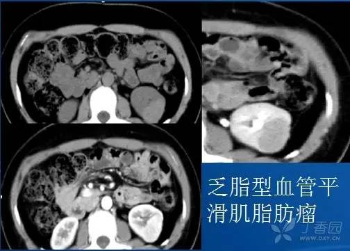 多图解析:肾脏肿瘤性病变的 CT 表现 多图解析:肾脏肿瘤性病变的 CT 表现