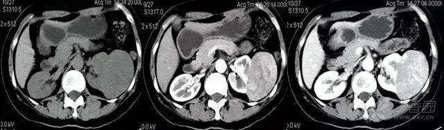 多图解析:肾脏肿瘤性病变的 CT 表现 多图解析:肾脏肿瘤性病变的 CT 表现