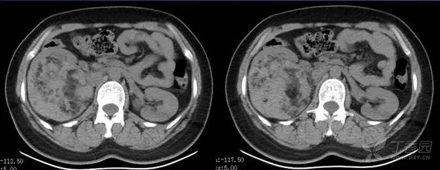 多图解析：肾脏肿瘤性病变的 CT 表现