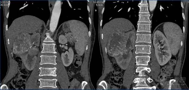 多图解析:肾脏肿瘤性病变的 CT 表现 多图解析:肾脏肿瘤性病变的 CT 表现