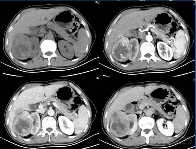 多图解析:肾脏肿瘤性病变的 CT 表现 多图解析:肾脏肿瘤性病变的 CT 表现