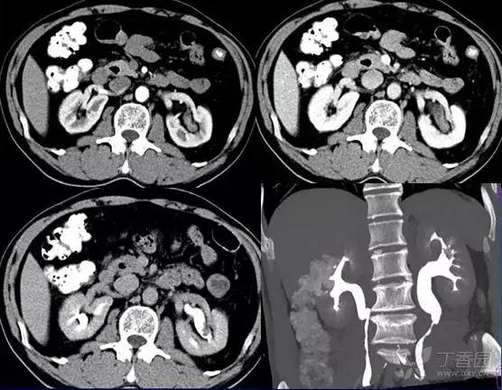 多图解析:肾脏肿瘤性病变的 CT 表现 多图解析:肾脏肿瘤性病变的 CT 表现