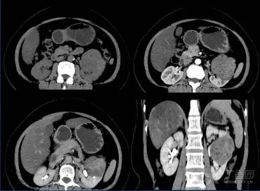 多图解析:肾脏肿瘤性病变的 CT 表现 多图解析:肾脏肿瘤性病变的 CT 表现