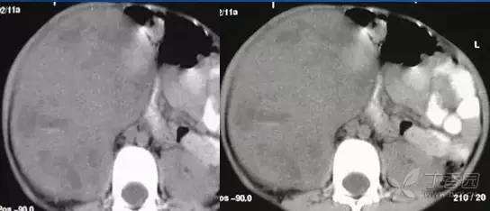 多图解析:肾脏肿瘤性病变的 CT 表现 多图解析:肾脏肿瘤性病变的 CT 表现