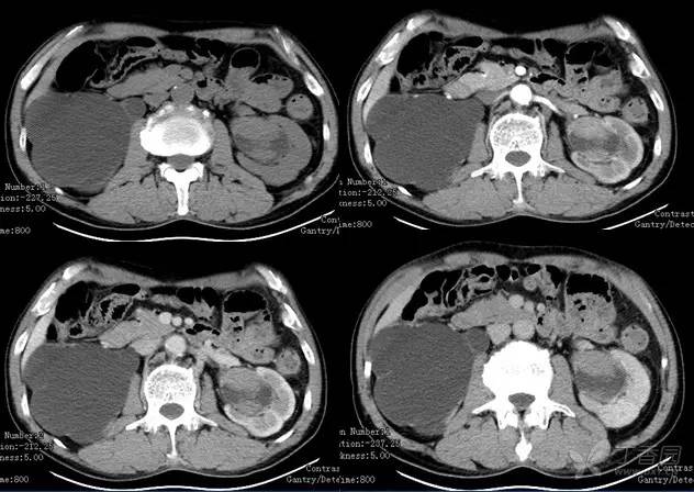 多图解析:肾脏肿瘤性病变的 CT 表现 多图解析:肾脏肿瘤性病变的 CT 表现