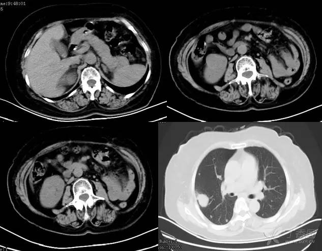 多图解析:肾脏肿瘤性病变的 CT 表现 多图解析:肾脏肿瘤性病变的 CT 表现