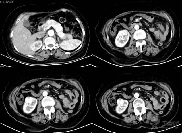 多图解析:肾脏肿瘤性病变的 CT 表现 多图解析:肾脏肿瘤性病变的 CT 表现
