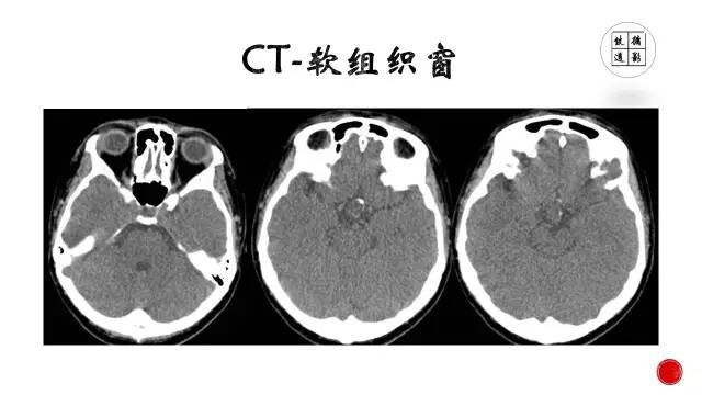 【病例】颅咽管瘤1例CT及MR影像表现