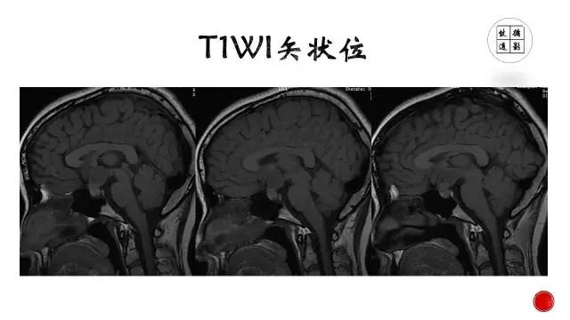 【病例】颅咽管瘤1例CT及MR影像表现