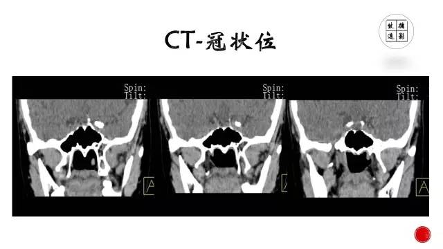 【病例】颅咽管瘤1例CT及MR影像表现