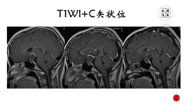 【病例】颅咽管瘤1例CT及MR影像表现