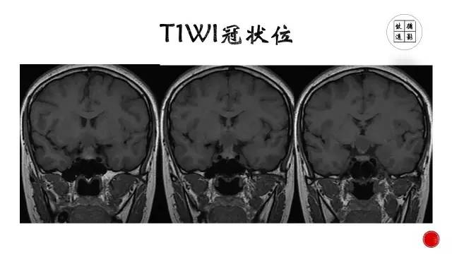 【病例】颅咽管瘤1例CT及MR影像表现