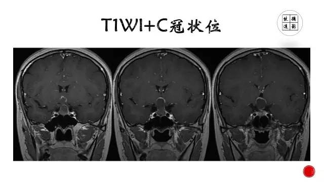 【病例】颅咽管瘤1例CT及MR影像表现