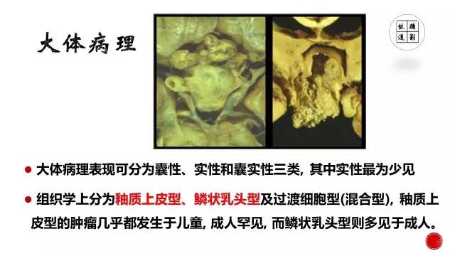 【病例】颅咽管瘤1例CT及MR影像表现