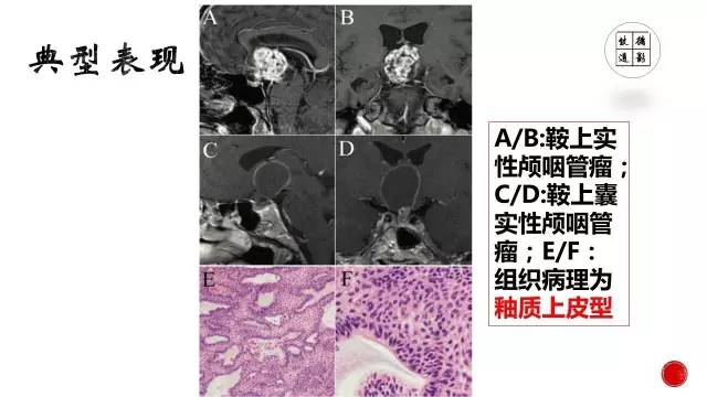 【病例】颅咽管瘤1例CT及MR影像表现