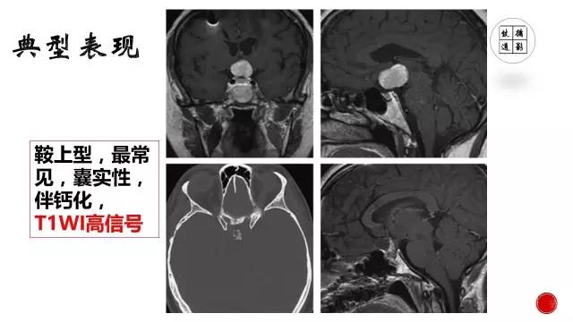【病例】颅咽管瘤1例CT及MR影像表现