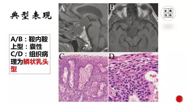 【病例】颅咽管瘤1例CT及MR影像表现