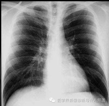 【病例】贲门失迟缓症1例X线及CT影像表现 【病例】贲门失迟缓症1例X线及CT影像表现