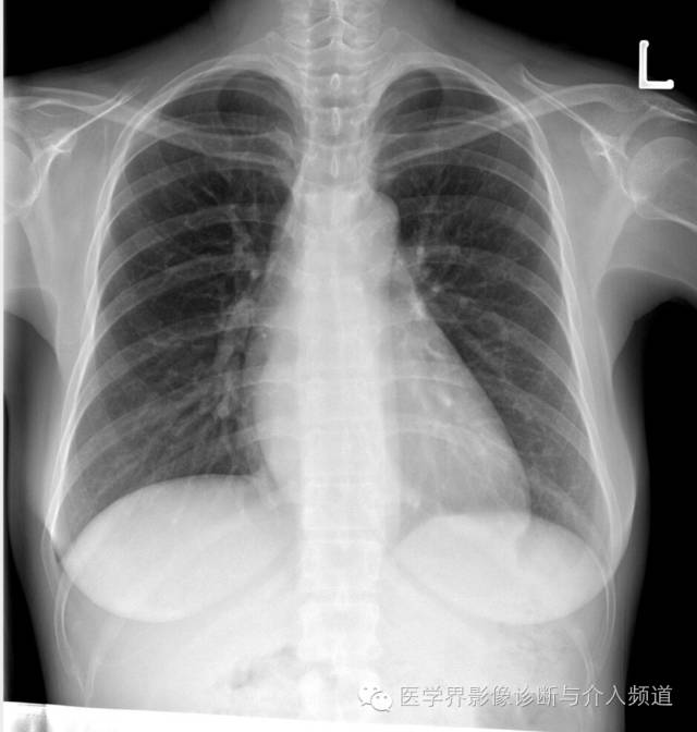 【病例】贲门失迟缓症1例X线及CT影像表现