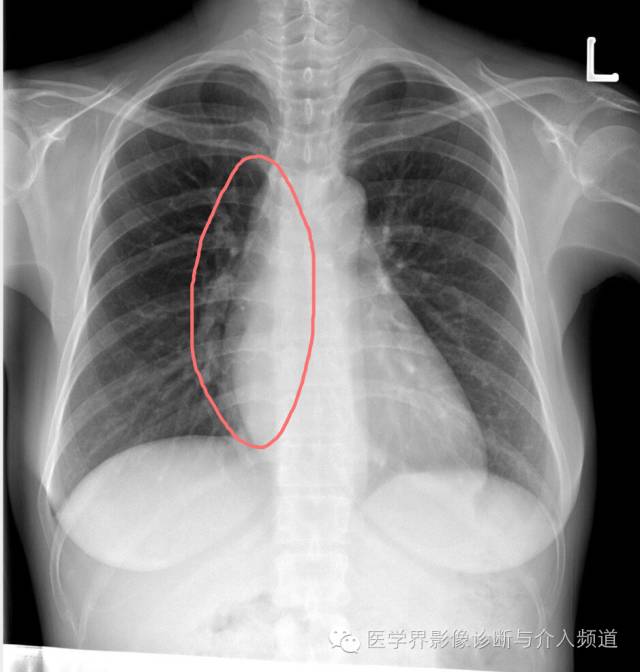 【病例】贲门失迟缓症1例X线及CT影像表现 【病例】贲门失迟缓症1例X线及CT影像表现