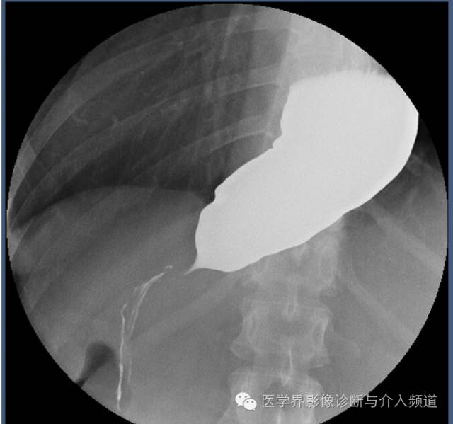 【病例】贲门失迟缓症1例X线及CT影像表现 【病例】贲门失迟缓症1例X线及CT影像表现
