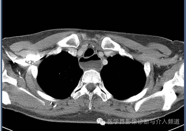 【病例】贲门失迟缓症1例X线及CT影像表现 【病例】贲门失迟缓症1例X线及CT影像表现