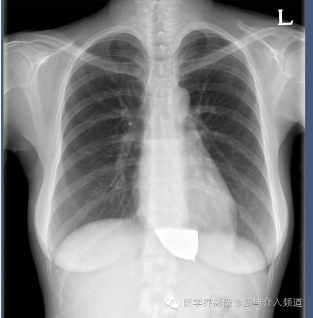 【病例】贲门失迟缓症1例X线及CT影像表现 【病例】贲门失迟缓症1例X线及CT影像表现