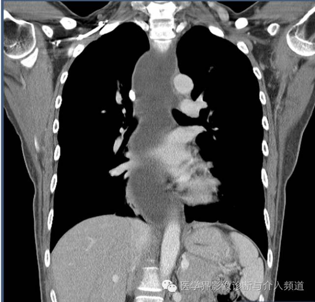 【病例】贲门失迟缓症1例X线及CT影像表现 【病例】贲门失迟缓症1例X线及CT影像表现